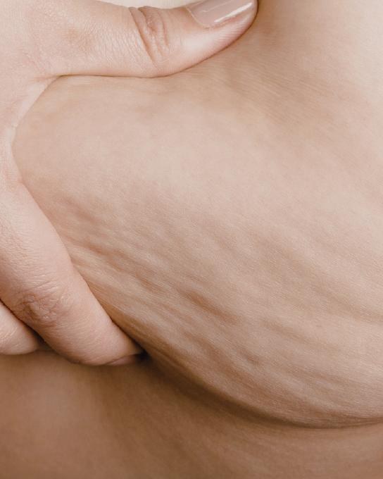 Celulitis